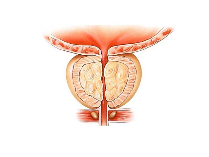 inflammation of the prostate gland