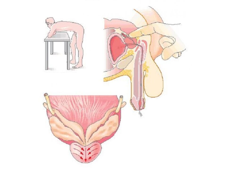 Prostate massage technique by a doctor to perform a secretion analysis